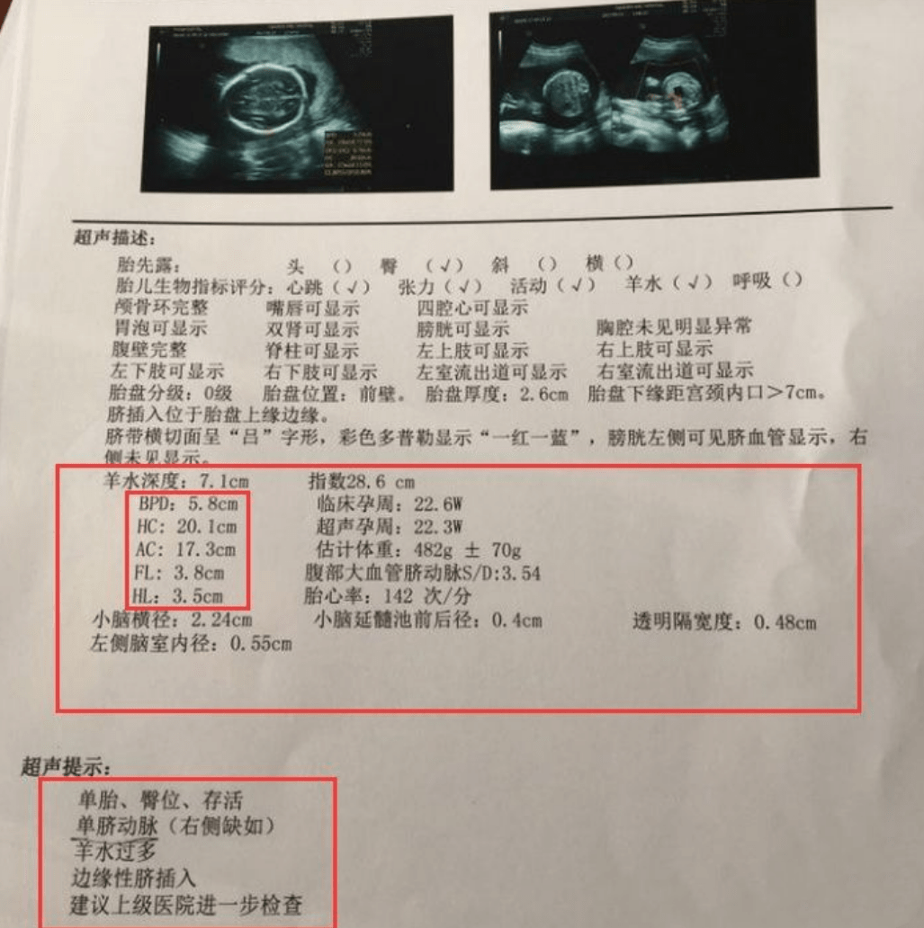 产检报告看不懂?