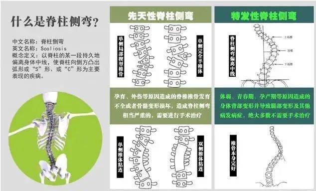 疾病防控丨共同关注儿童脊柱侧弯_孩子_part_青少年
