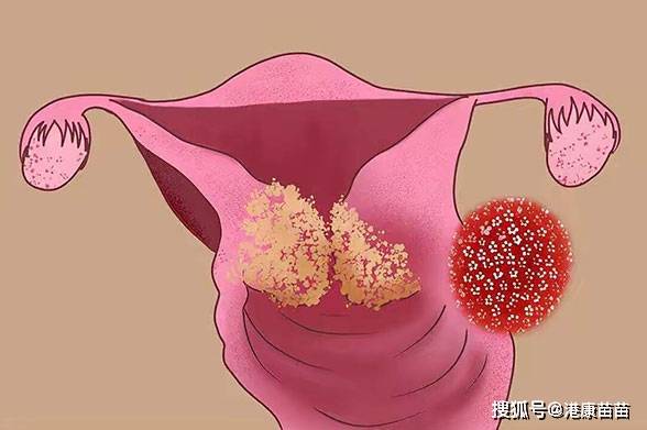 我是如何感染hpv病毒的?有哪些感染途径?如何预防
