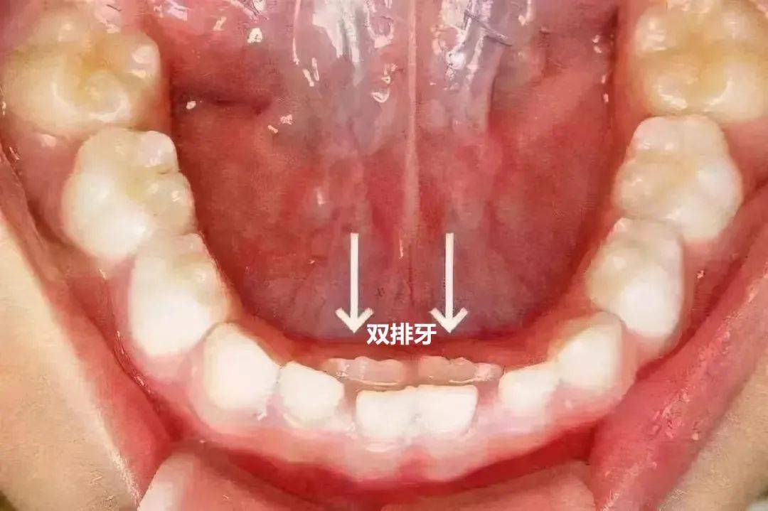 科学育儿|儿童牙齿早期护理指南_宝宝_乳牙_口腔