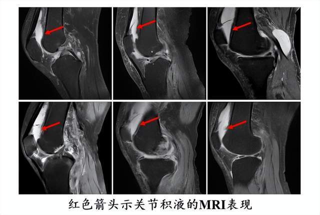 了解关于膝关节的八大误区,跟着专家来“避坑”