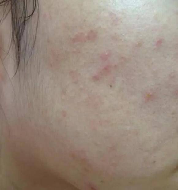广州供卵自怀（型男必看！男士油痘肌自救指南！男士油皮水乳正确使用方法）