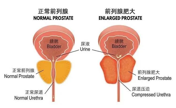 造成前列腺肥大的原因