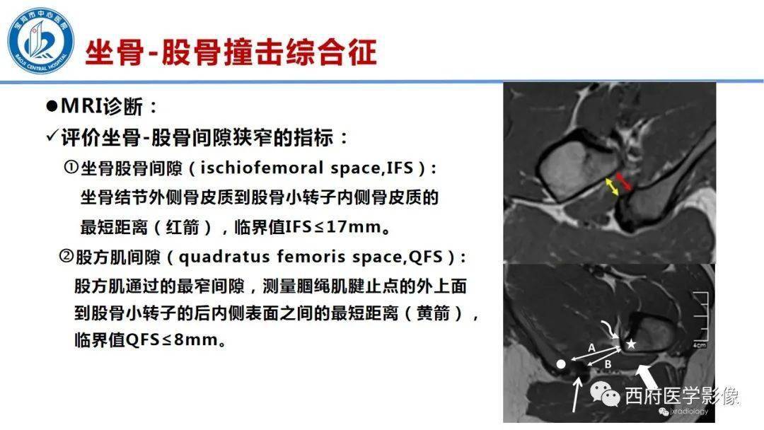 坐骨 股骨撞击综合征mri诊断与鉴别