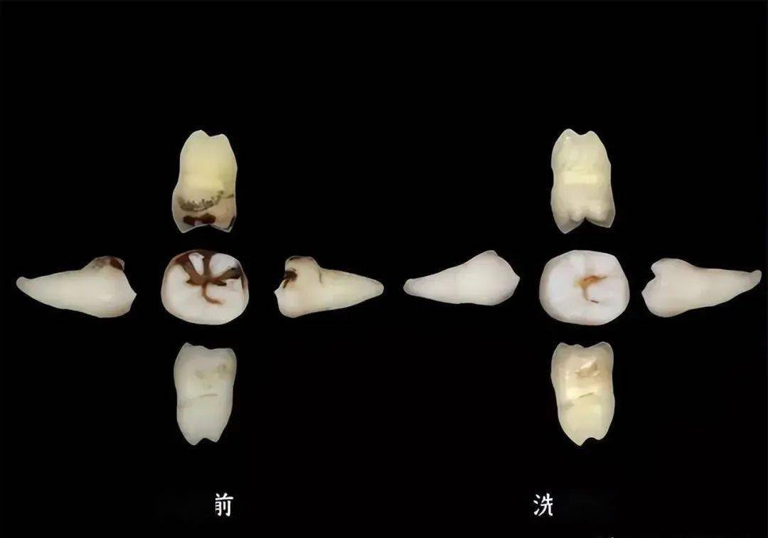 牙缝里的牙结石，若何肃清清洁？那3个法子是很多人的选择！