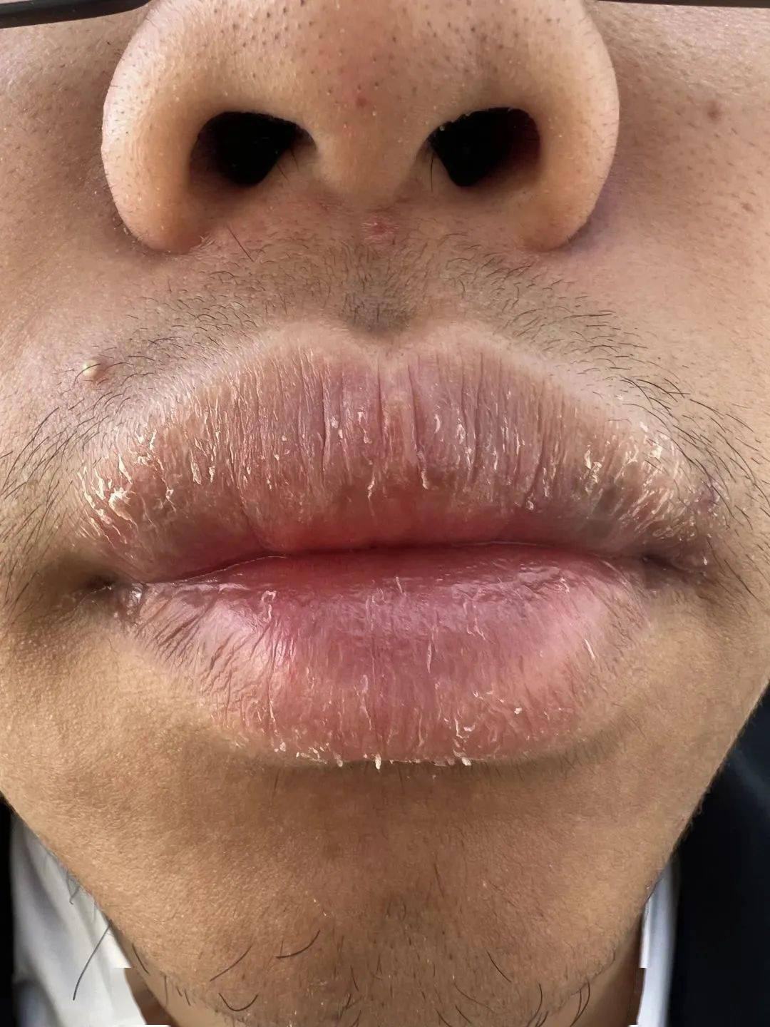 中医治疗唇炎有妙方