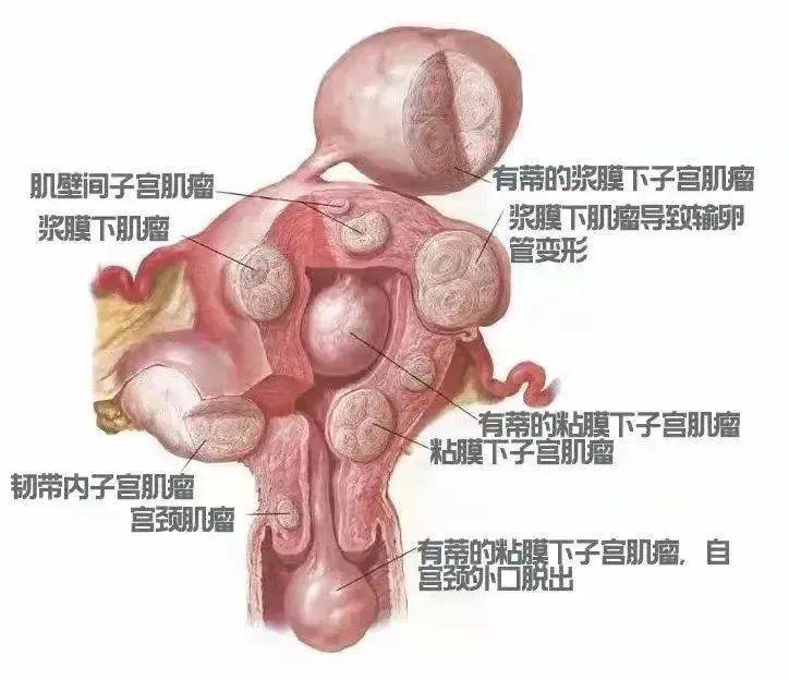 【妇幼技术】宫腔镜下子宫肌瘤切除术