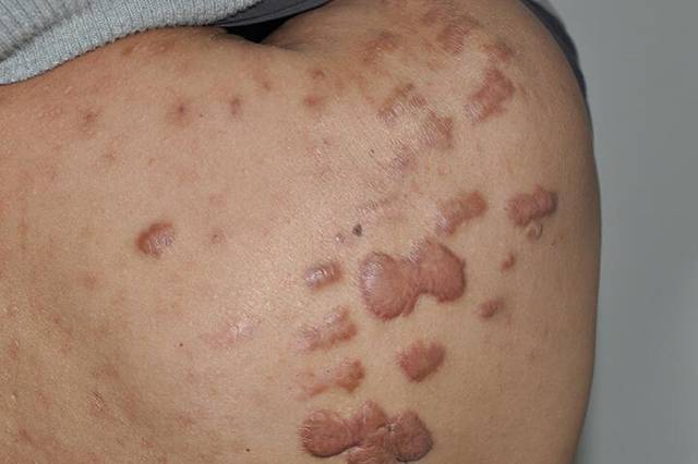 上海长江疤痕医院刘彦玲科普:疙瘩可以去除吗?