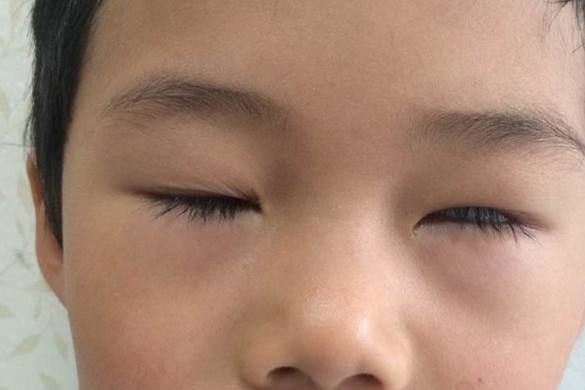 眼睛睁不开?你不是没睡好,可能是病