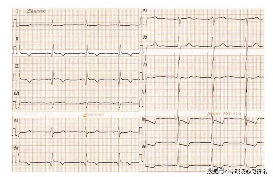 山羊老师:心电图机记录要点_电压