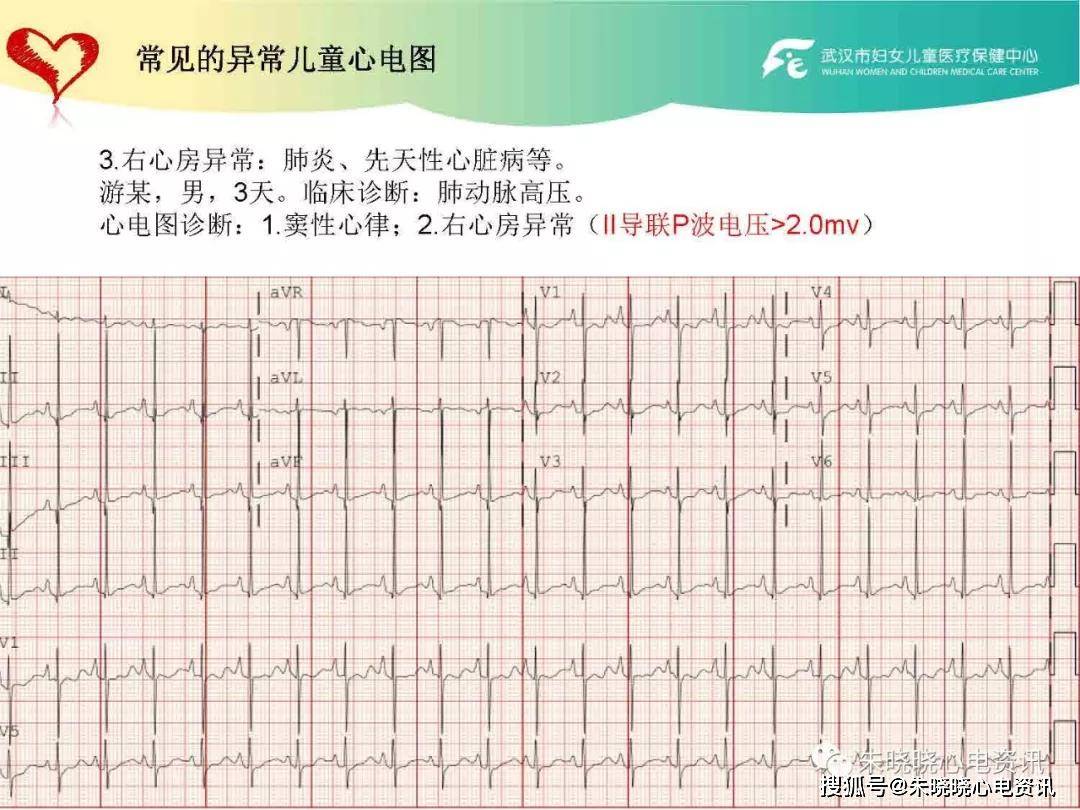 儿童心电图