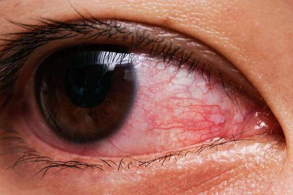 结膜炎前期有5个症状 别再忽视 对眼睛不利 分泌物