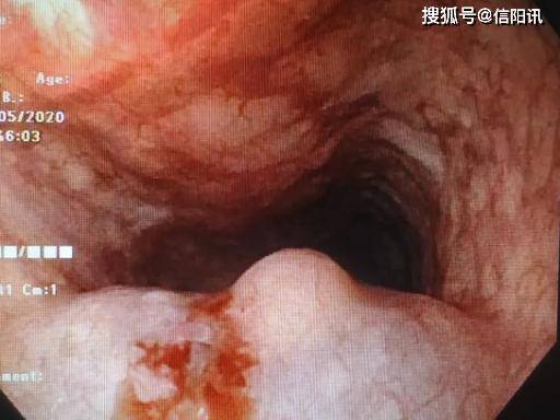 商城縣中醫院率先在我縣開展首例食管黏膜下良性腫瘤經消化內鏡微創