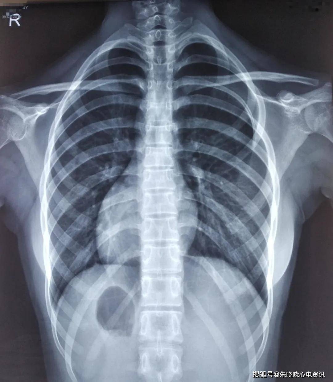 镜像右位心的f导联心电图特征读析