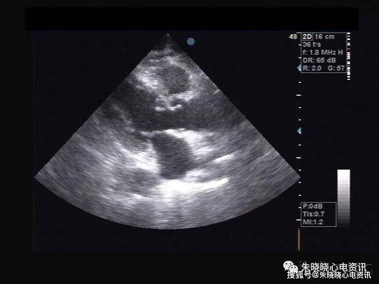 镜像右位心的 f 导联心电图特征读析