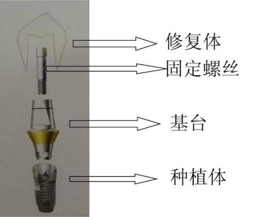 種植牙的優勢在哪裡?7個理由讓你選擇種植牙-樂山安普口腔