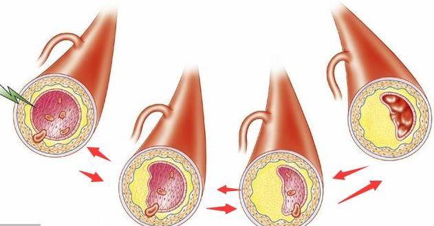 高血脂易引發血管堵塞醫生家中常備這3物血脂降血管通