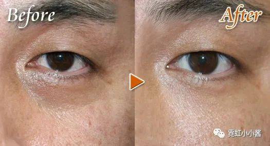 皱纹,松弛,眼袋, 眼部问题大全 解决方法|日本医美_皮肤