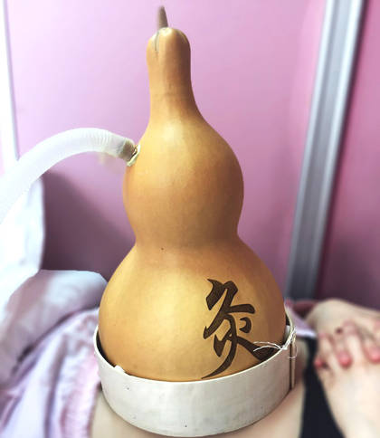 【徐浦葫芦灸】这葫芦里到底卖的什么"药"?