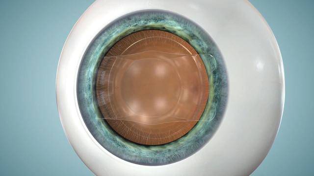 4种近视眼手术详细过程,最贵的不一定最靠谱!_角膜