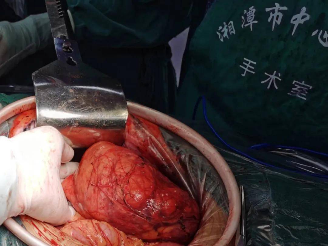 体检查出腹膜后巨大肿瘤, 湘潭市中心医院多科协作联合成功"拆弹"