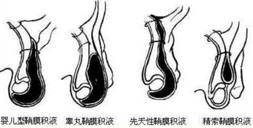 睾丸鞘膜积液吃什么好 睾丸鞘膜积液饮食注意事项