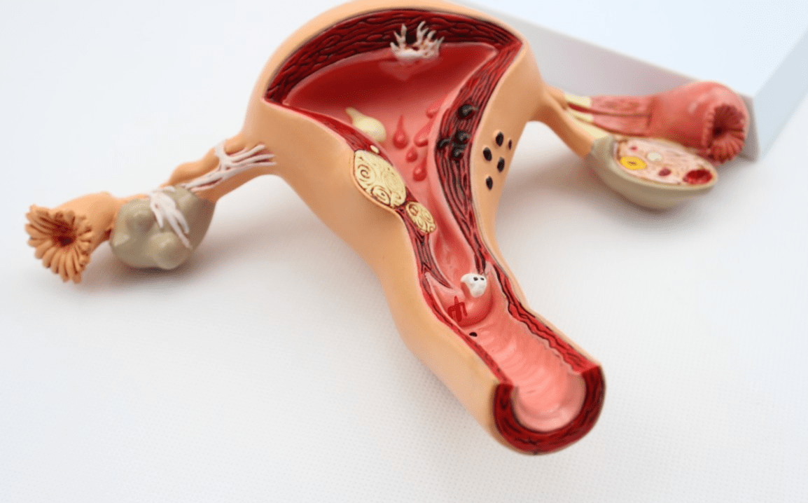 巧克力囊肿6年备孕无果生殖专家给出这4点优化方案终获孕