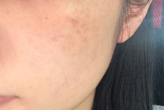 做完皮秒4天出现色沉咋整皮秒激光后脸多久恢复集美们快看