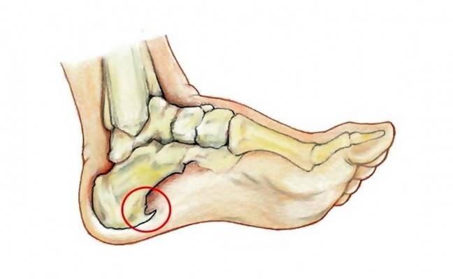 脚后跟不红也不肿可钻心疼难道是长骨刺了