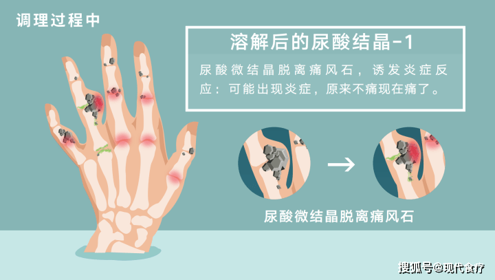 痛风调理新策略：从现代医学到自然疗法