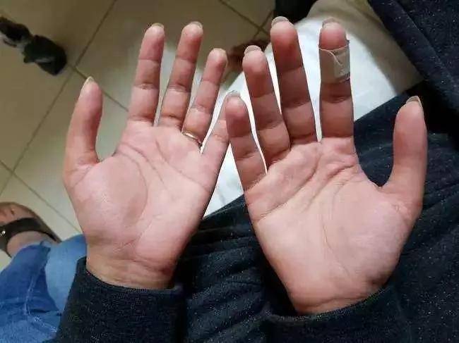 julia gnuse能够透光的手指,还能看到里面的血管!