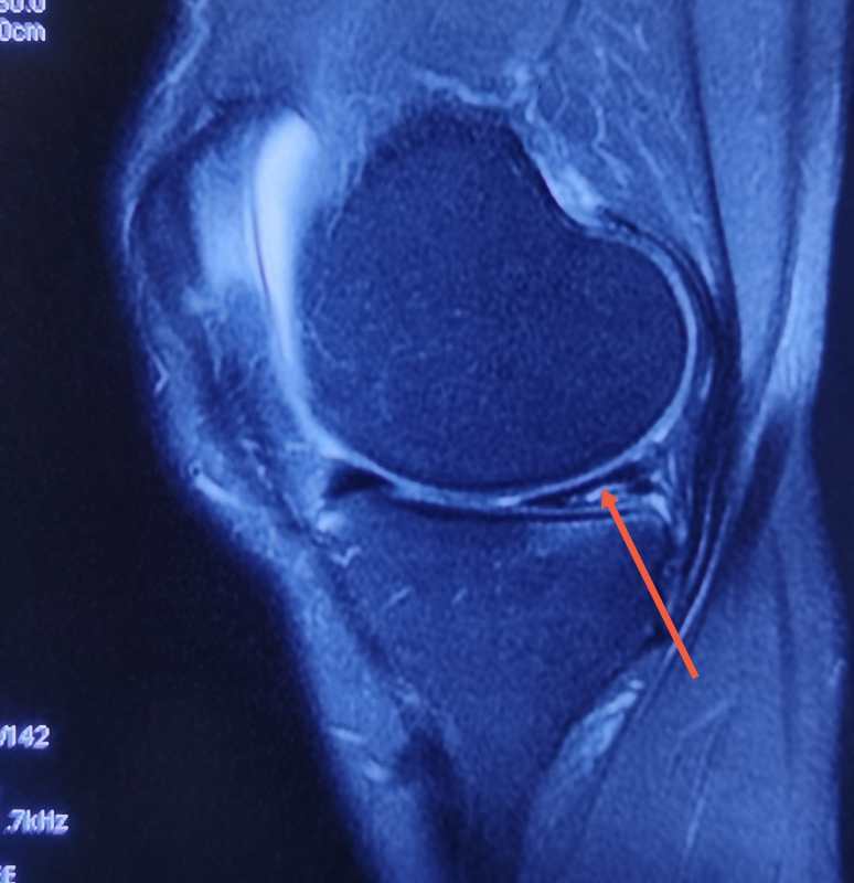 左膝内侧半月板图片