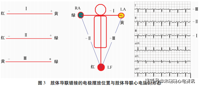 心电图图解 肢体图片