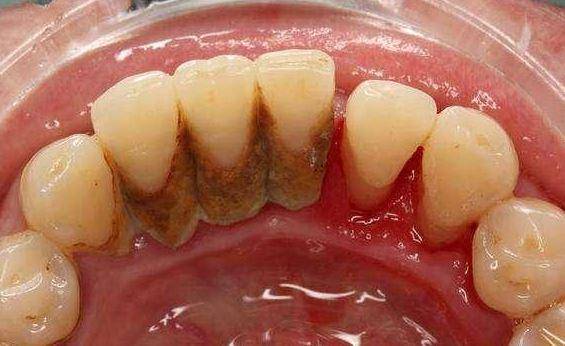 牙结石对人的影响