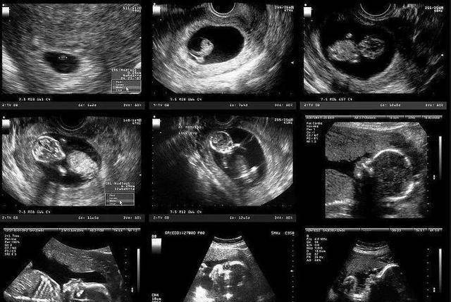 孕期最后一个月,孕妇遵循三做二不做,胎儿出生更顺利