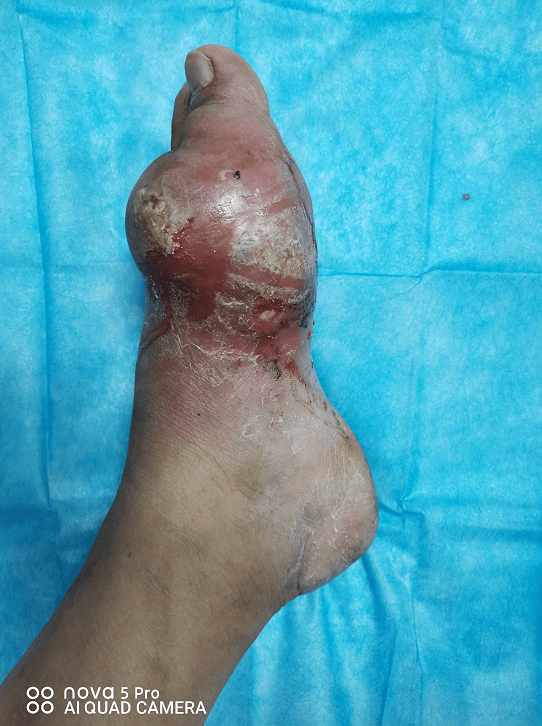 14年"痛风"患者双足红肿溃烂,原来他私自做了这件事!_尿酸