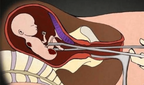 当胎盘脱离子宫,排出体外,这种强制终止胎儿妊娠的过程相当于一次手术