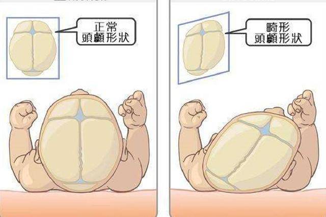原创宝宝偏头睡觉有危害,及时纠正是重点,3个调整方案宝妈赶紧记下