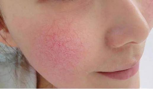 别人刷酸变美,你刷完却烂脸?看完这篇你就懂了!