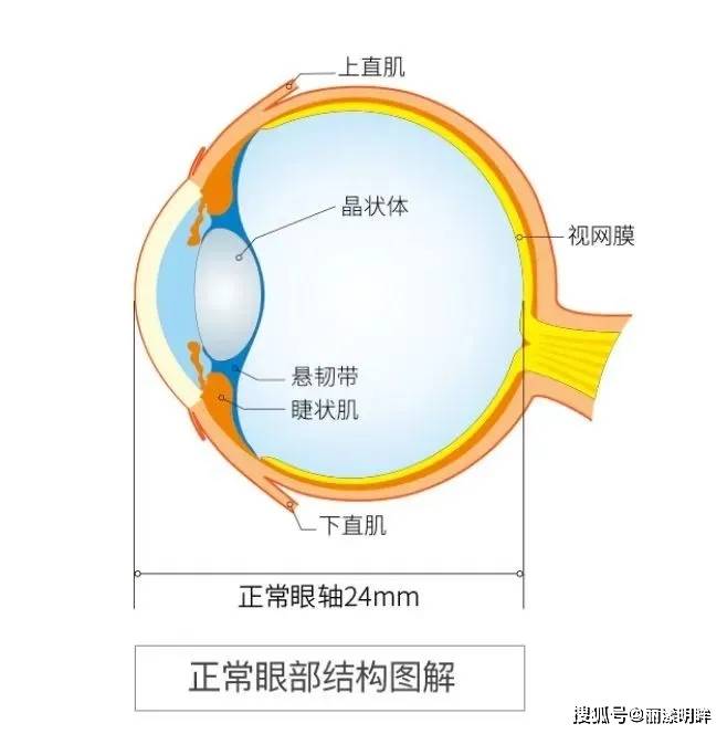 又称轴性近视,是由于先天或后天因素(如不注意用眼卫生),使眼球前后径