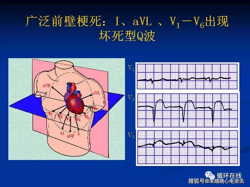 心肌梗死相关血管与心电图改变(ppt)