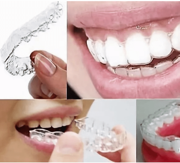 只想矫正半口牙?好像不太行!