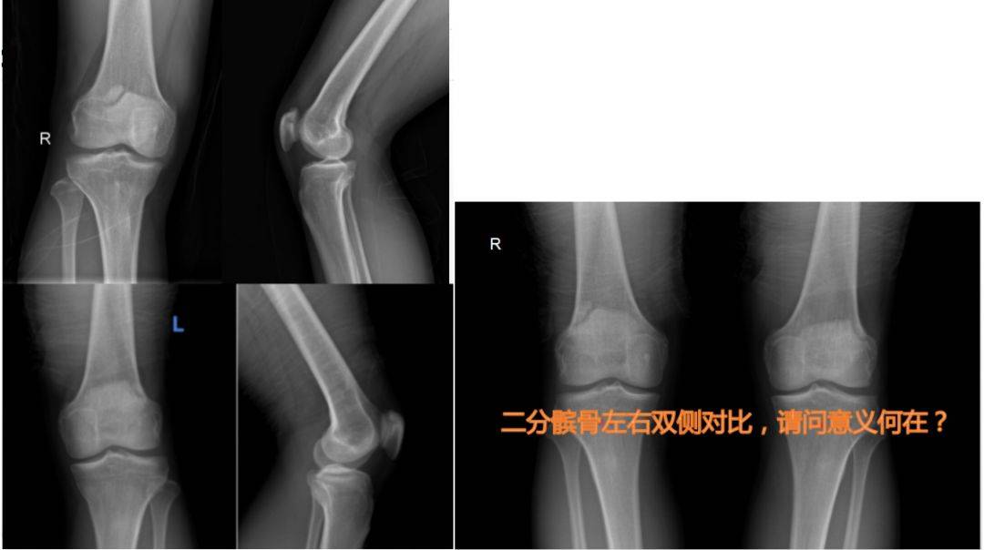 這些看片技巧不可錯過!_髕骨