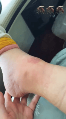 乔欣脚被蚊子咬后肿成"猪蹄" 在线发文求消肿方法