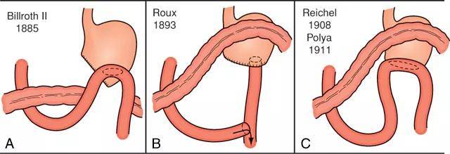 胃手术方式图解图片