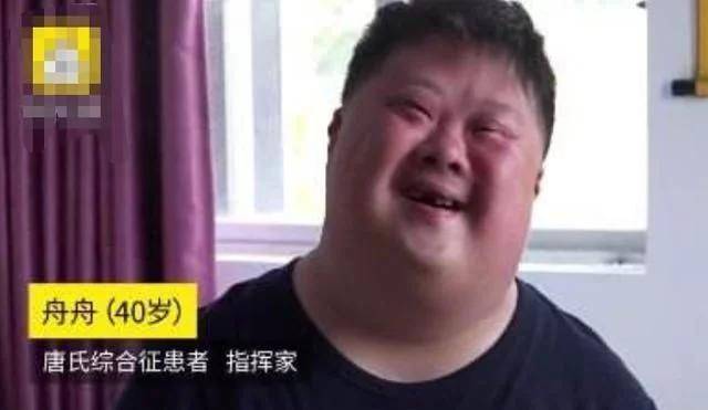 什么是唐氏综合征图片