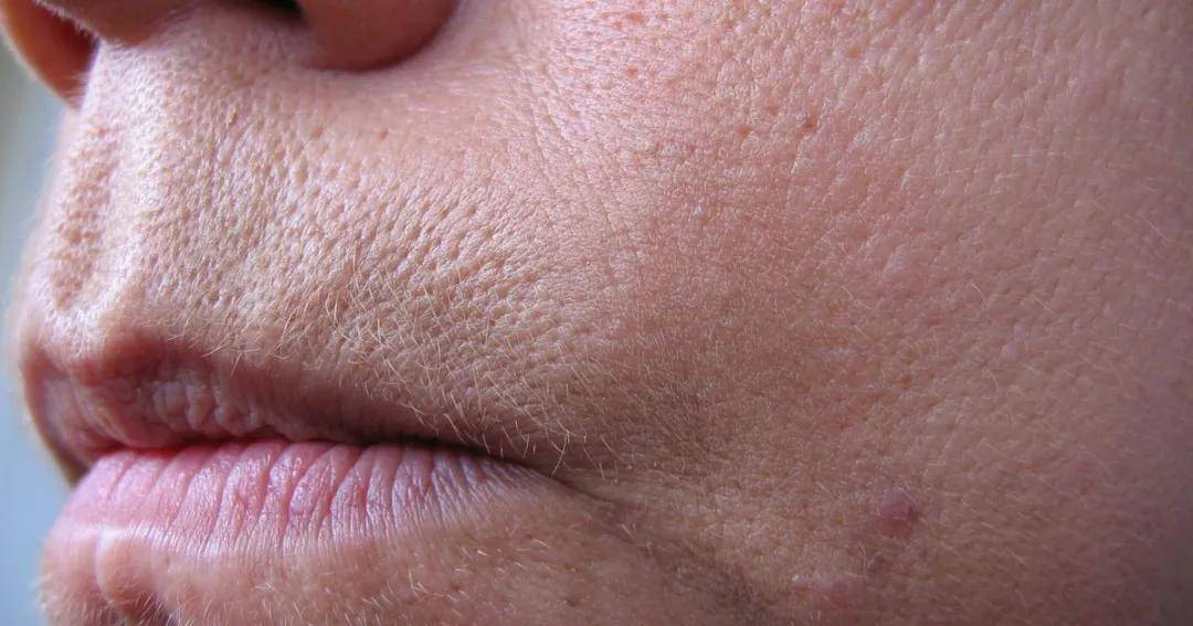 很多人以为毛孔粗大只和油有关系,所以频繁使用一些酒精含量高的或者