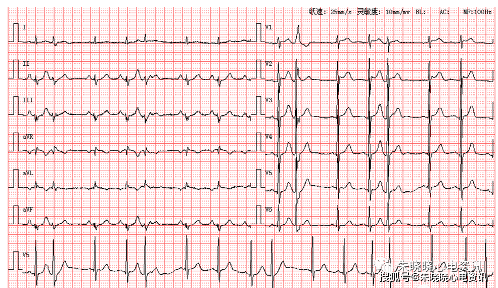 房早未下传心电图图片图片