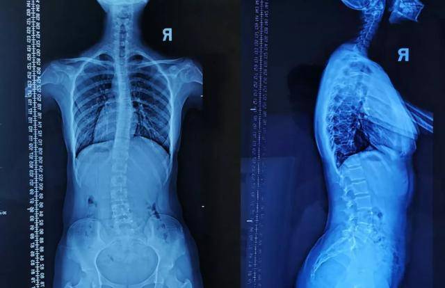 30% 16岁的李同学在脊柱筛查公益活动中 被查出疑似脊柱侧弯
