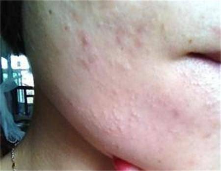 痘痘经常在同一个地方复发?痘痘是否真有“痘根”一说_挤压